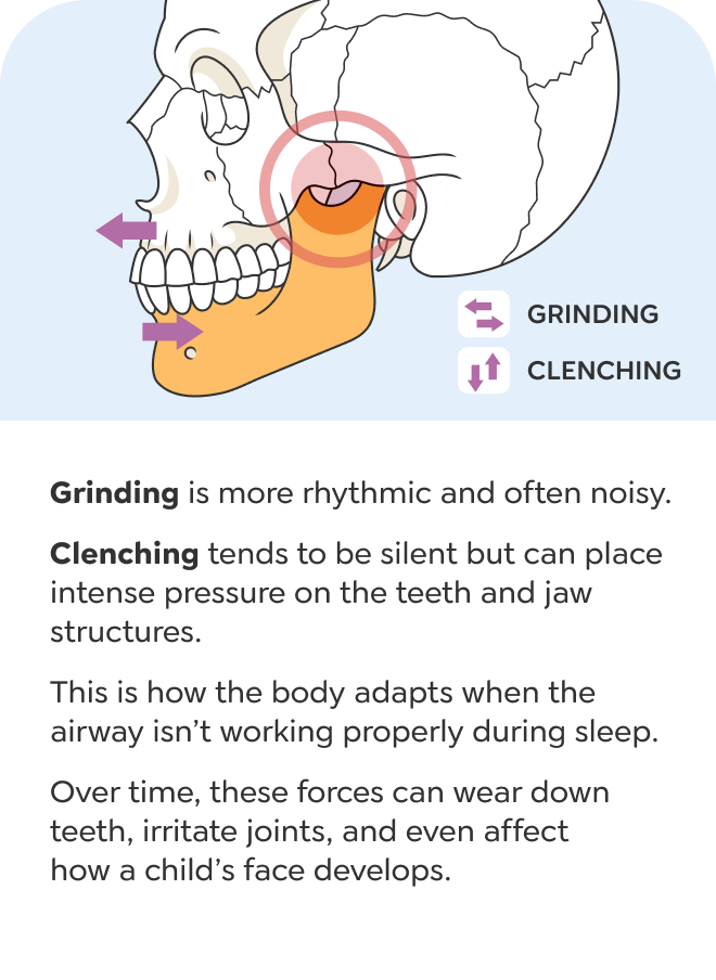 Mouth breathing slide 3