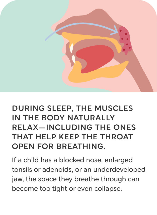 Mouth breathing slide 4