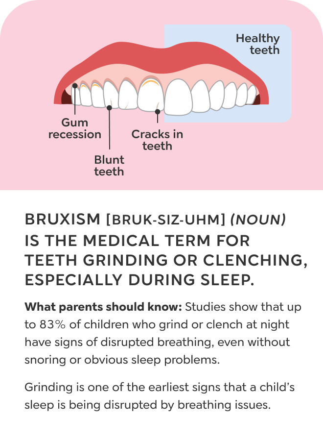 Mouth breathing slide 6